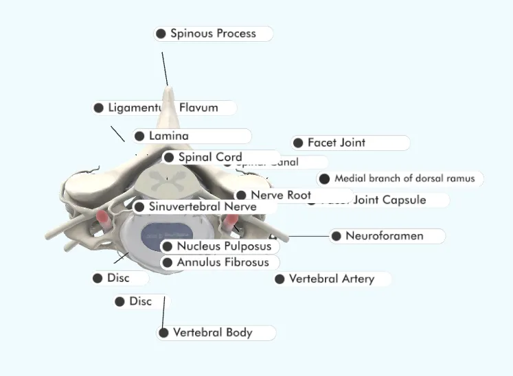 Anatomy diagram of a vertebra with labeled parts including spinal cord, nerves, and vertebral body.