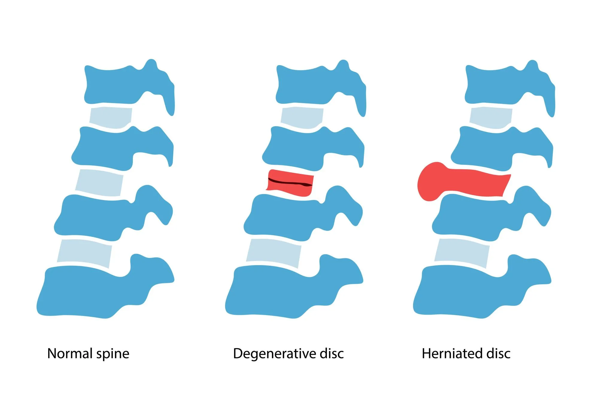 Degenerative Disc Disease 08-20-24 .jpg
