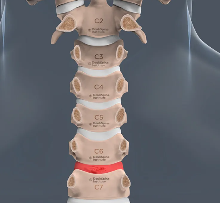 Illustration of the cervical spine, highlighting vertebrae C2 to C7, with C6-C7 disc in red.
