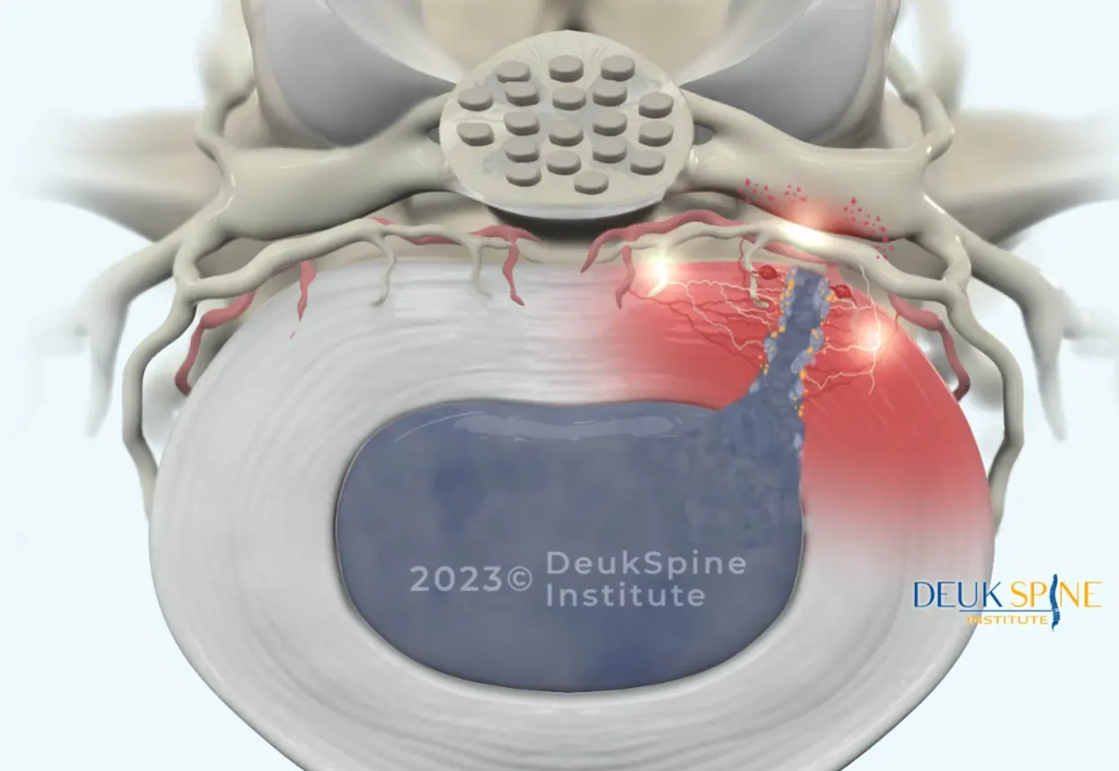 Medical illustration of a spinal disc herniation with highlighted nerve irritation.