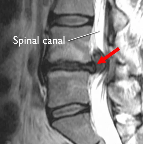 MRI of a herniated disc in the lower back.png