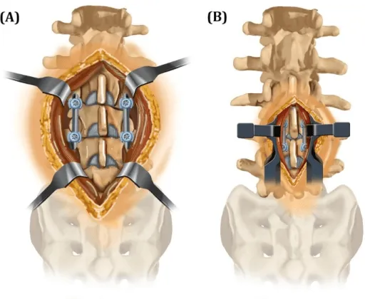 Illustration showing the incision exposing the spine and the metal rods and screws used in a PLIF
