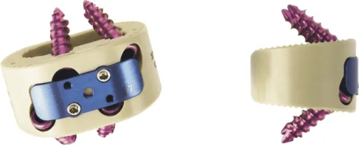 Illustration of a metal cage used to hold vertebrae in place during a PLIF