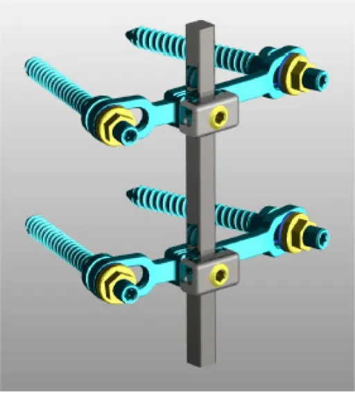 The hardware rods and screws used for a PLIF