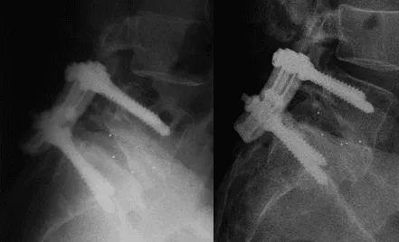 Xray showing the metal cage and hardware for a L5-S1 PLIF