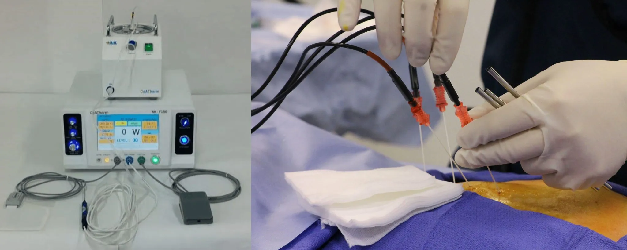A split image showing radio frequency ablation equipment; a medical procedure in progress with gloved hands manipulating ablation needles on a patient.