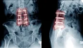 A 3-level fusion, the metal hardware has immobilized the spine, reducing natural movement and stressing adjacent spinal joints.