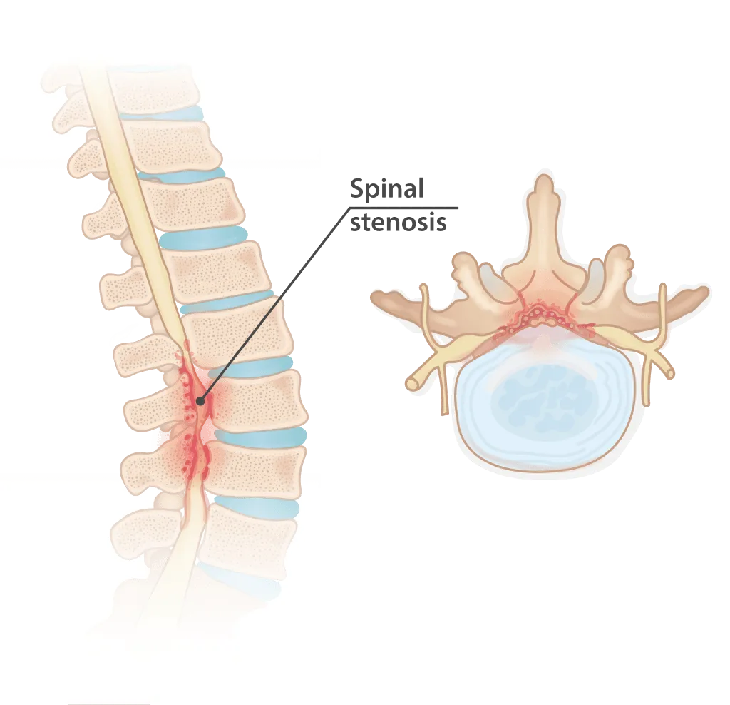 image of spinal stenosis