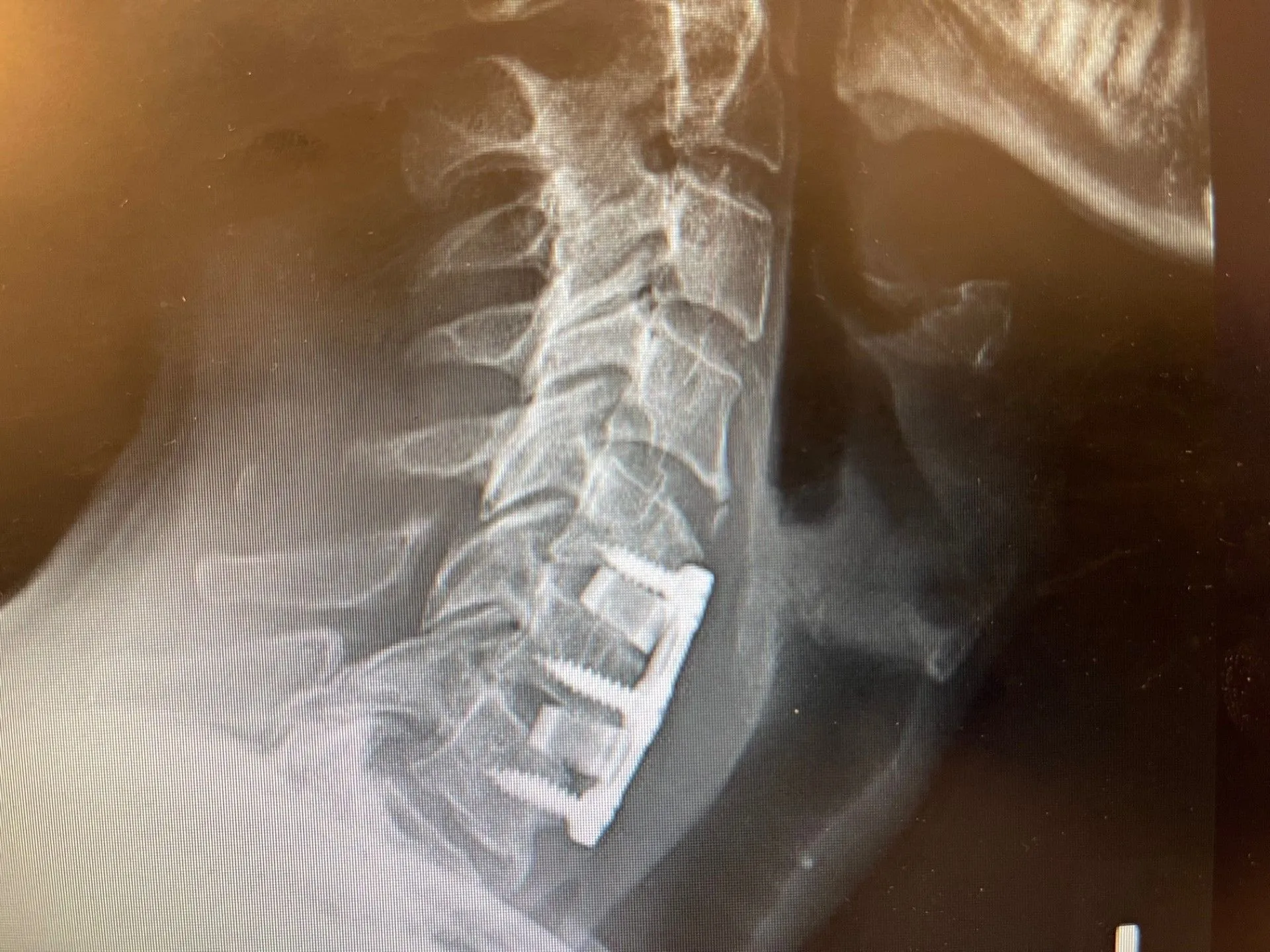 A CT scan of 3 level cervical fusion depicting complications.