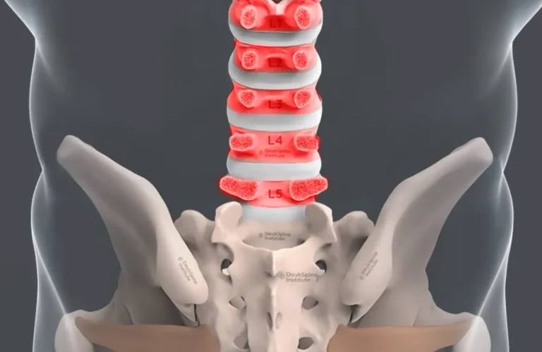 Illustration of the lumbar spine highlighting L1 to L5 vertebrae in red for emphasis.