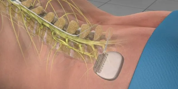 Animation showing the abbot spinal cord stimulator placed along the spine.