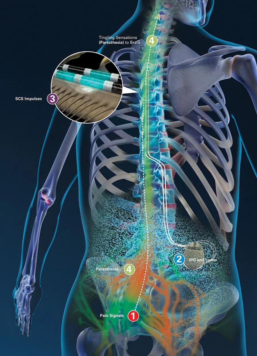 Illustration of spinal cord stimulation showing impulses and pain signal pathways.