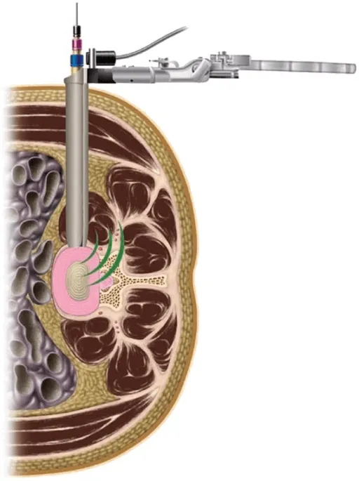 XLIF illustration.png