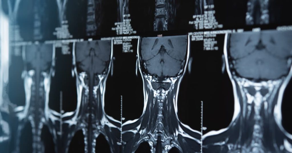 MRI scans of the cervical spine showing the ACDF alternative technique.