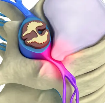 A animation showcasing pinched nerve due to a herniated disc.