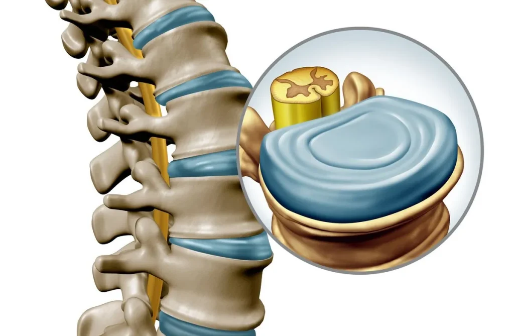 Illustration of a spine segment with a close-up of a vertebral disc and spinal cord cross-section.