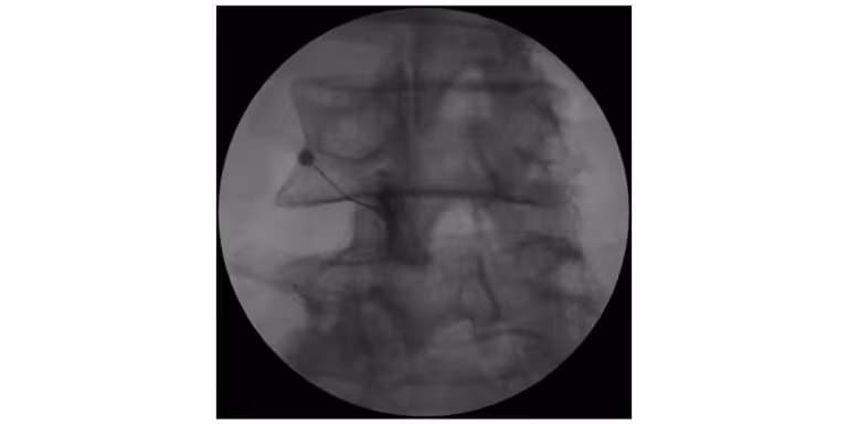 X-ray image showing the placement of a needle in the spine during a medical procedure.