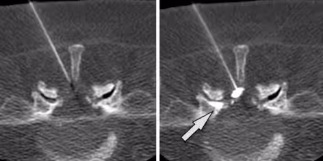 CT scan of a spine shows a needle targeting a spinal area, with an arrow indicating the entry point.