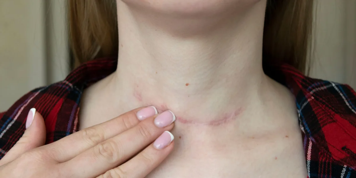 A person shows a healing scar on their neck from anterior cervical corpectomy surgery.