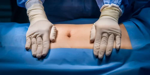 Surgeon prepares stomach for ALIF surgery incision