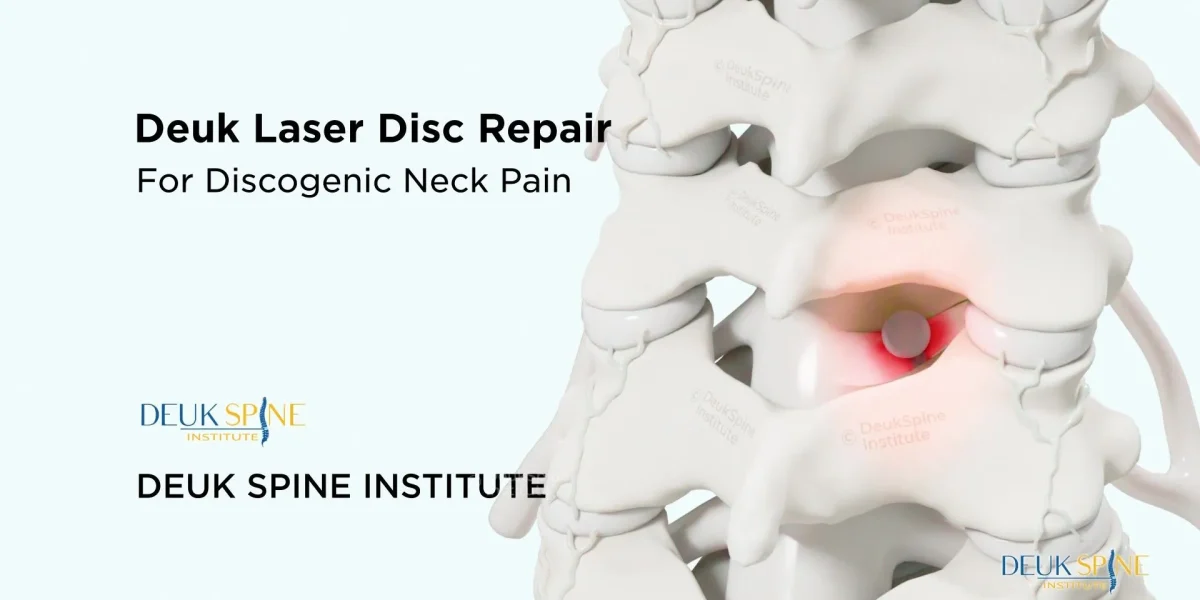 Illustration of Deuk Laser Disc Repair for discogenic neck pain, highlighting affected cervical disc area.