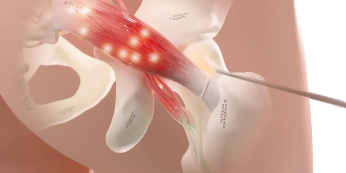 Illustration of Deuk Piriformis Release procedure showing targeted muscle and surrounding anatomy.