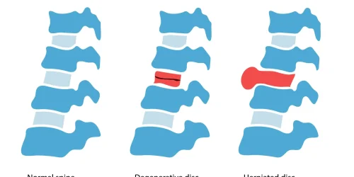 Illustration comparing normal, degenerative, and herniated spinal discs.