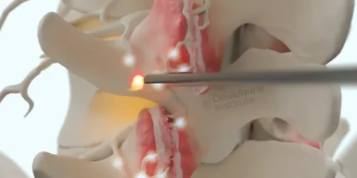 Deuk Plasma Rhizotomy A medical illustration of a spinal procedure using a laser on a highlighted disc.