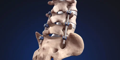 example of lumbar fusion with rods and screws.jpg