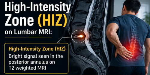 Diagram of a high-intensity zone in lumbar MRI with a person holding their lower back.
