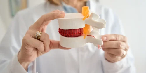 Doctor holding a spinal disc model illustrating a herniated disc pressing on a nerve.