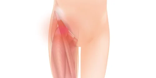 Illustration of herniated disc affecting hip and leg muscles, highlighting nerve compression.