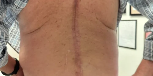 Patient with laminectomy scar starting at shoulders to the bottom of the torso