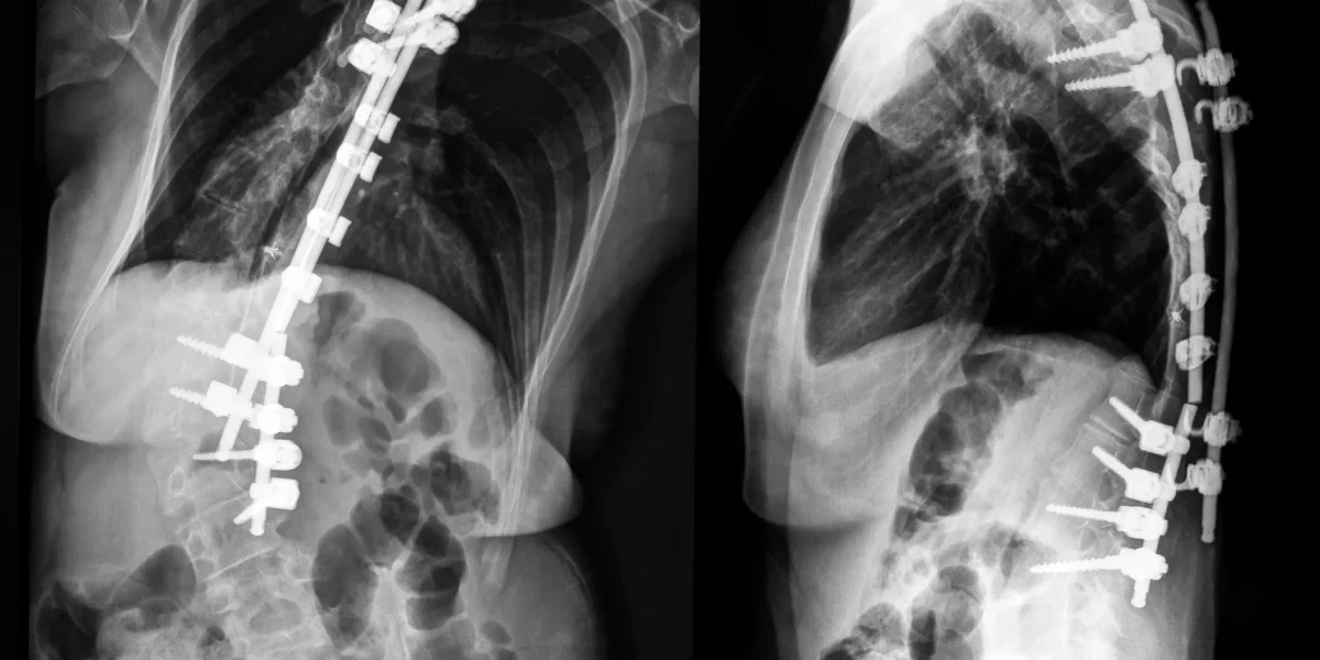 X-ray images showing spinal fusion with metal rods and screws in the spine.