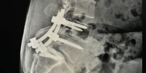 Example of metal hardware placed in body during spinal fusion