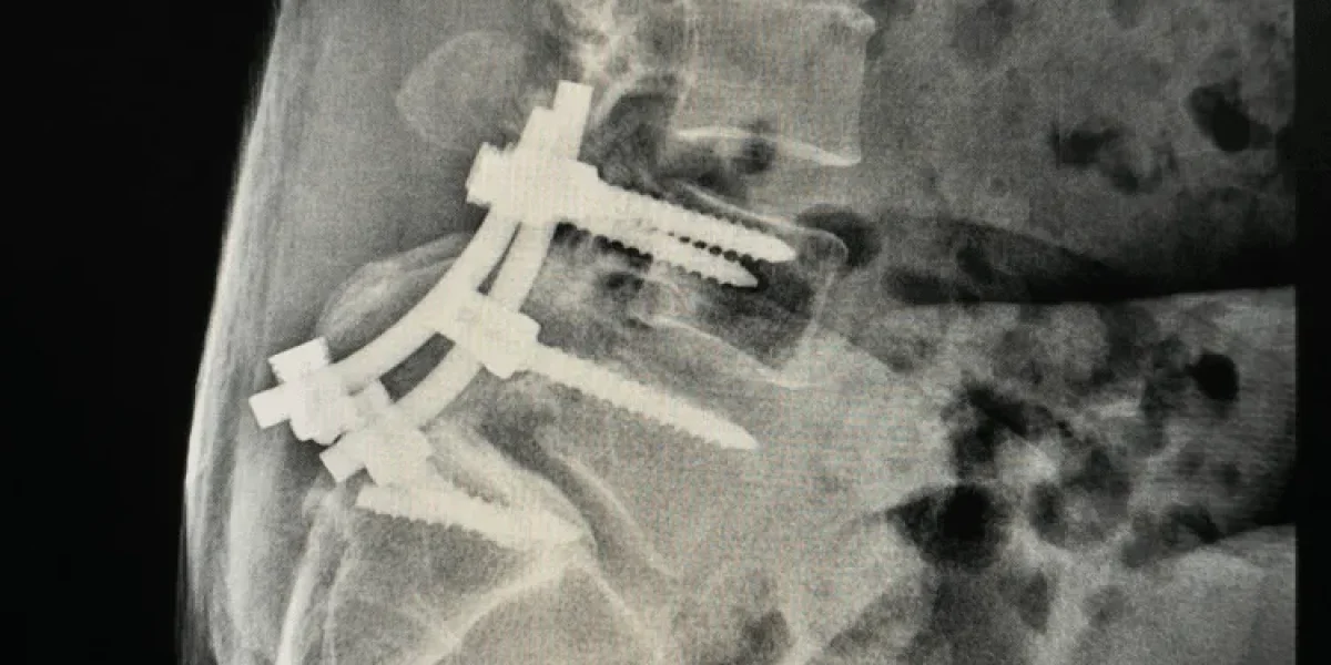 Example of metal hardware placed in body during spinal fusion