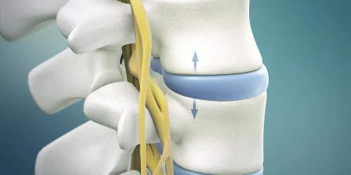 Illustration of a herniated disc between vertebrae compressing a nerve.
