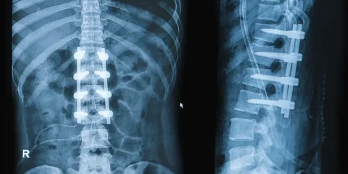 Spinal Fusion Surgery.png