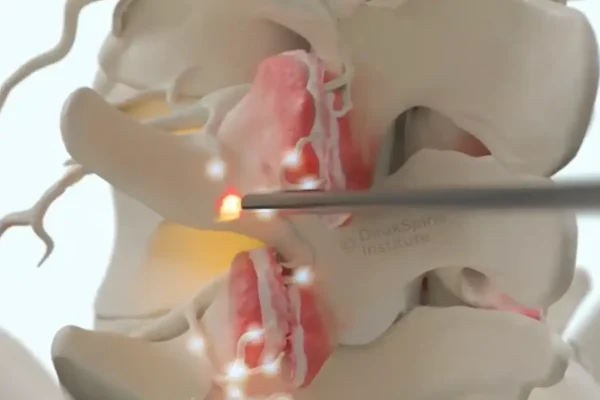 Model of a spine with a tool applying heat to a disc, illustrating a medical procedure.