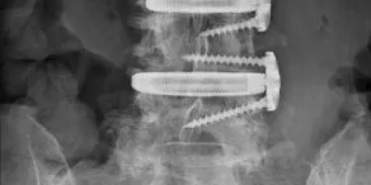 X-ray of a completed XLIF surgery with metal rods screws, and cages
