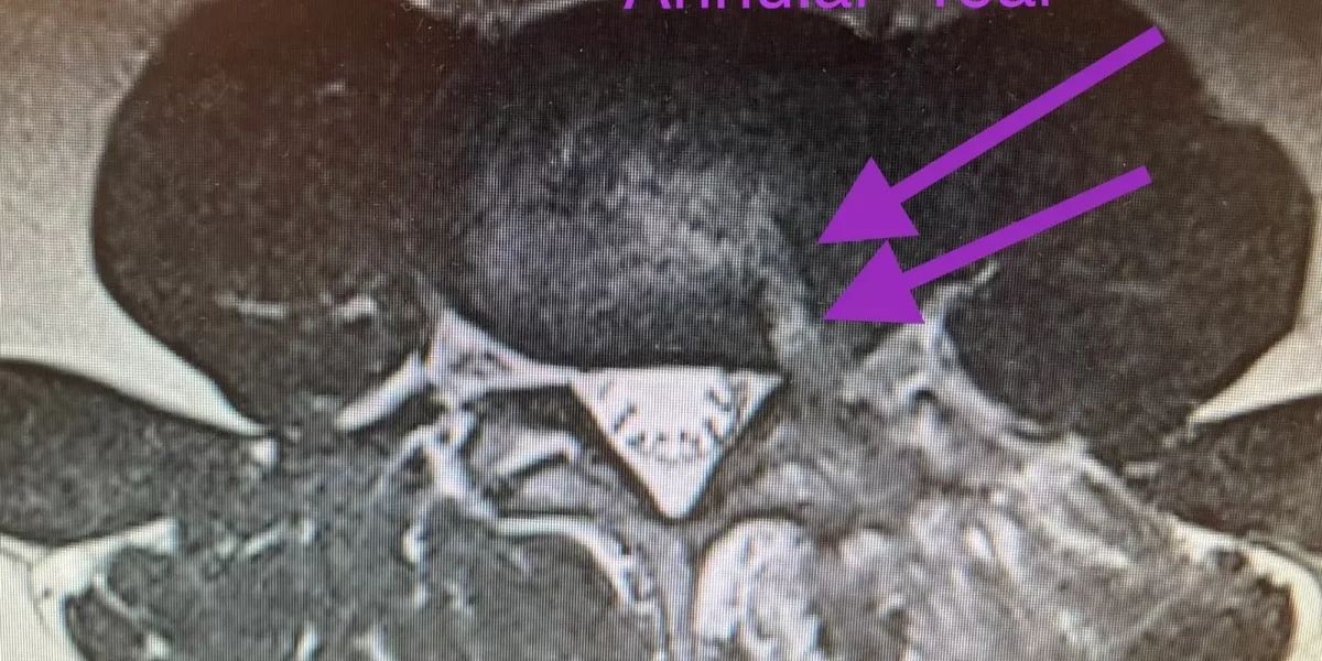 An axial view of a spine cross section showcasing annular tear with the arrows.