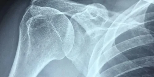 x-ray style image of human shoulder