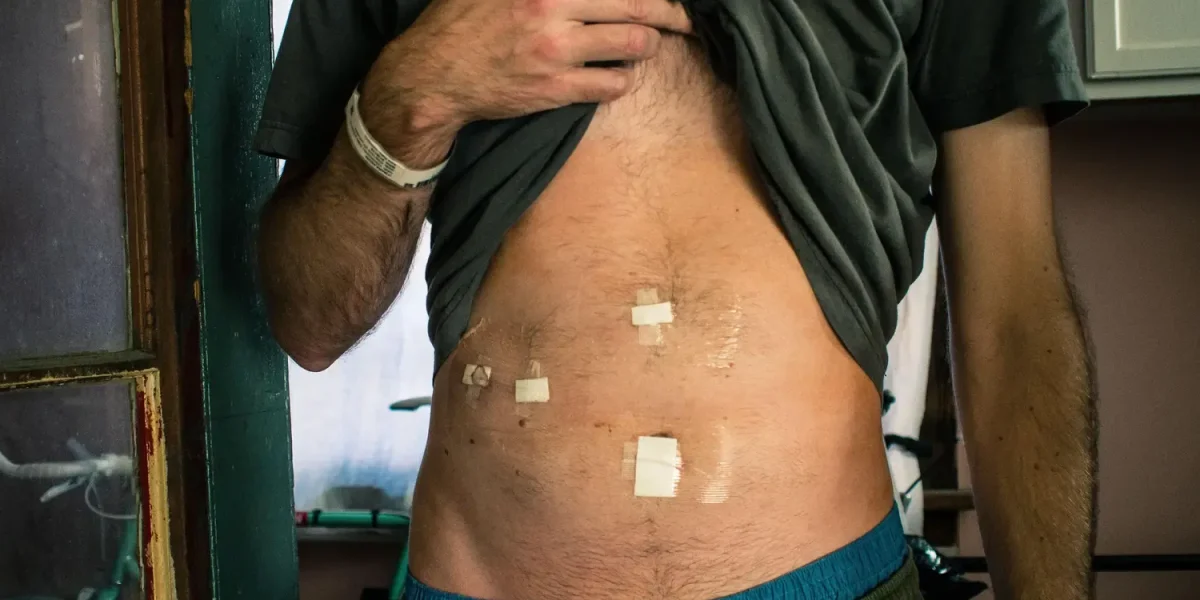 Man lifting shirt to show abdomen with surgical scars and bandages.