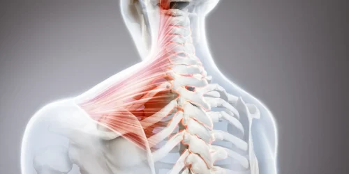 Illustration of a herniated disc in the cervical spine, highlighting affected muscles and vertebrae.