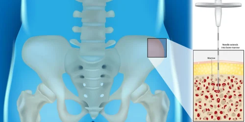 Graphic of BMAC therapy, a regenerative treatment for healing and pain management..