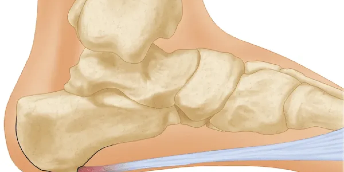Illustration of a heel spur on a human foot, highlighting bone growth and pain points.