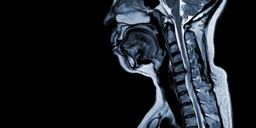 MRI image showing a C5-C6 disc herniation in the cervical spine.