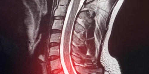 MRI scan showing C6-C7 disc herniation.