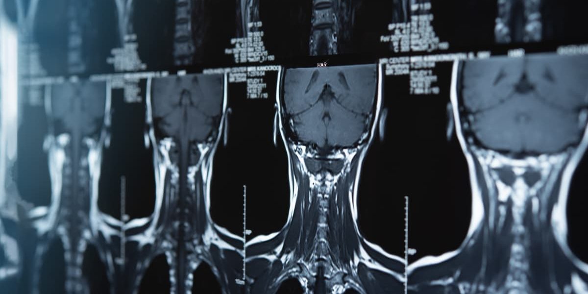 MRI scans of the cervical spine showing the ACDF alternative technique.