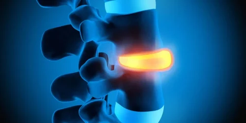 degenerative disc disease
